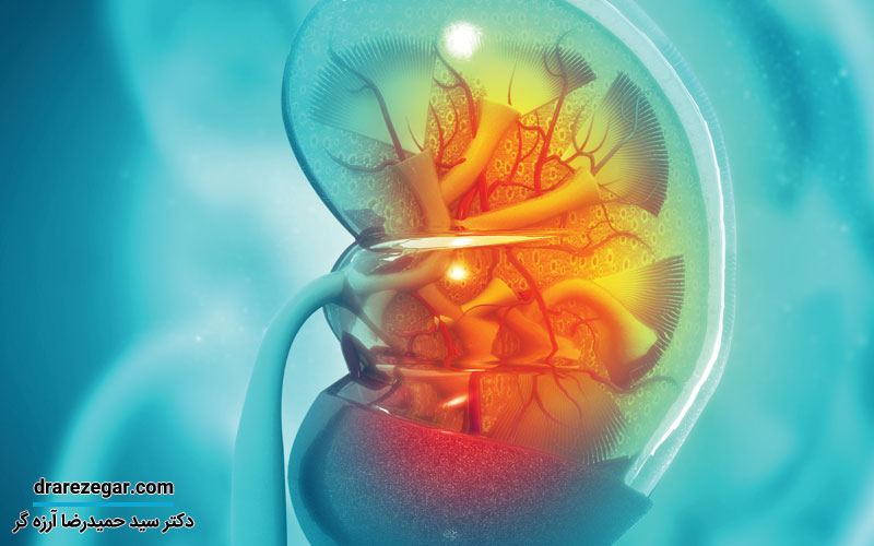 چکار کنیم سنگ کلیه یا سنگ حالب نسازیم