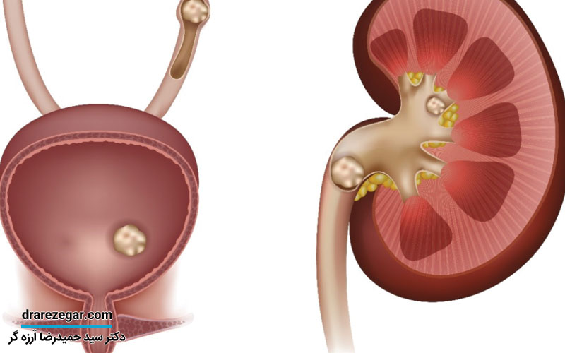 چکار کنیم سنگ کلیه یا سنگ حالب نسازیم