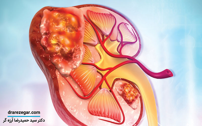 آیا سرطان کلیه کشنده است