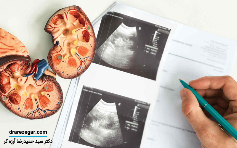 آیا سرطان کلیه کشنده است