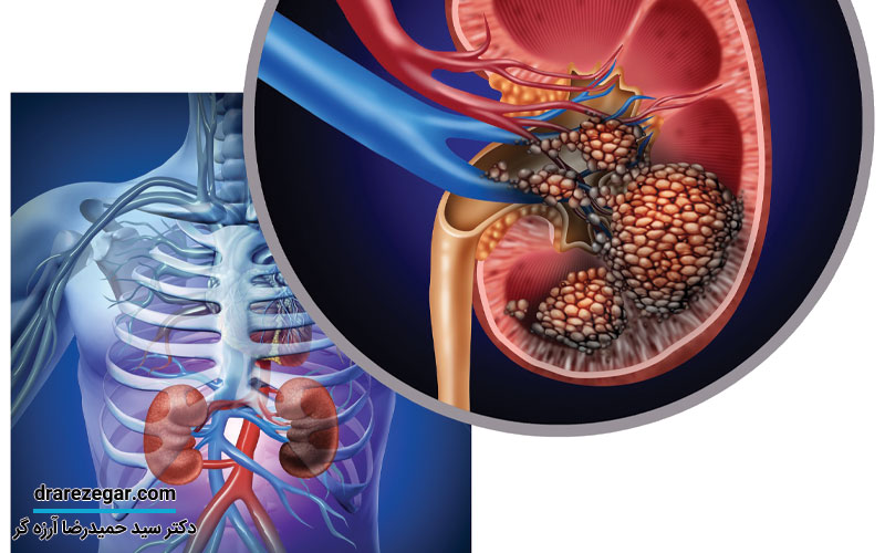 آیا سرطان کلیه کشنده است