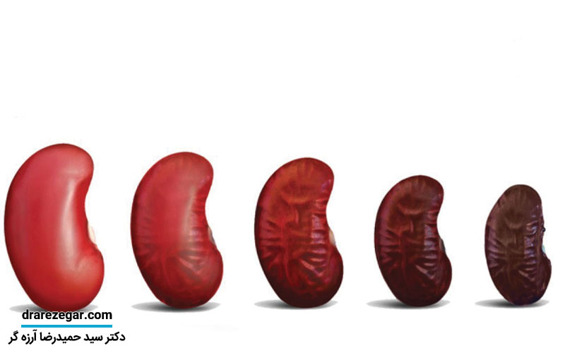 علت کوچک شدن کلیه چیست