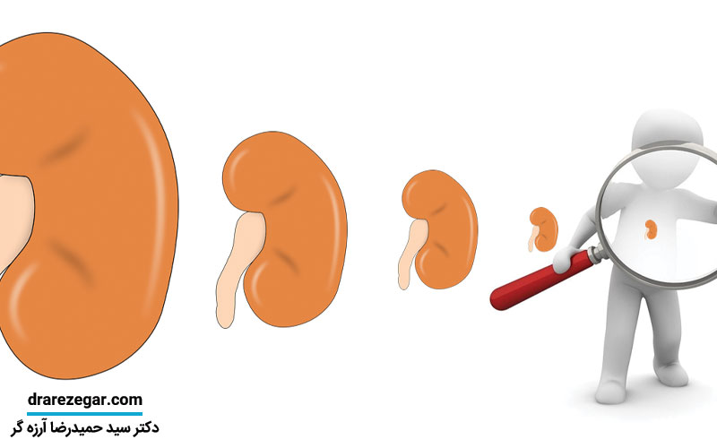 علت کوچک شدن کلیه چیست