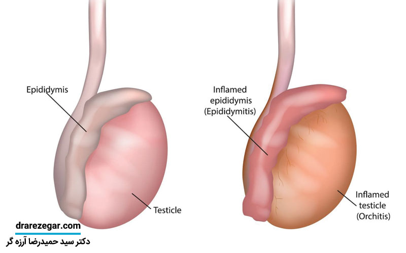 درمان قطعی اورکیت چیست