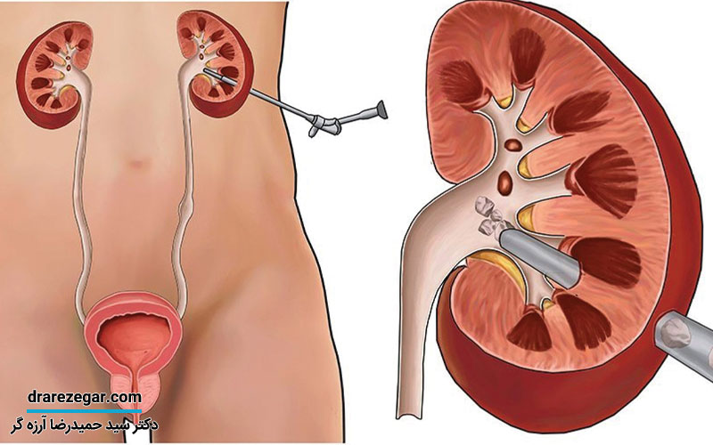 آنچه باید پیش از عملPCNL بدانید