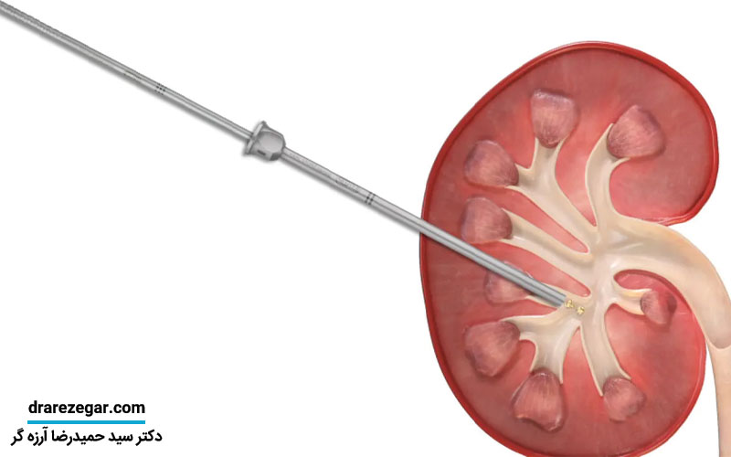 آنچه باید پیش از عملPCNL بدانید