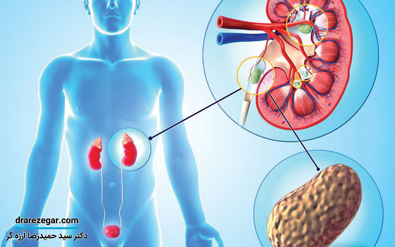 آیا سنگ کلیه باعث افزایش قند خون می شود