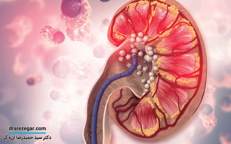 آیا سنگ کلیه باعث افزایش قند خون می شود