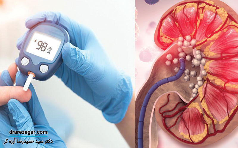 آیا سنگ کلیه باعث افزایش قند خون می شود