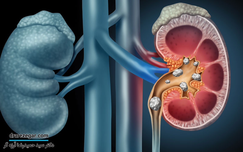 از کجا بفهمیم سنگ کلیه دفع شده است