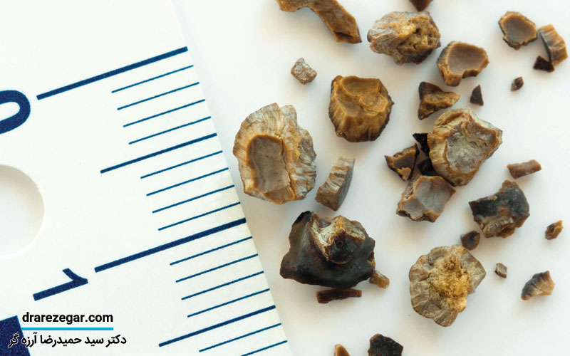 از کجا بفهمیم سنگ کلیه دفع شده است