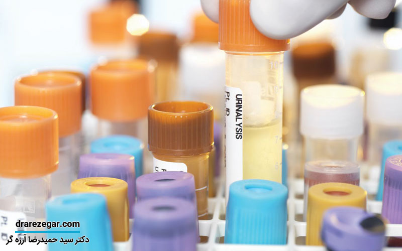 شایع ترین آزمایش های اورولوژی