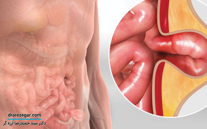 فتق یا باد فتق چیست