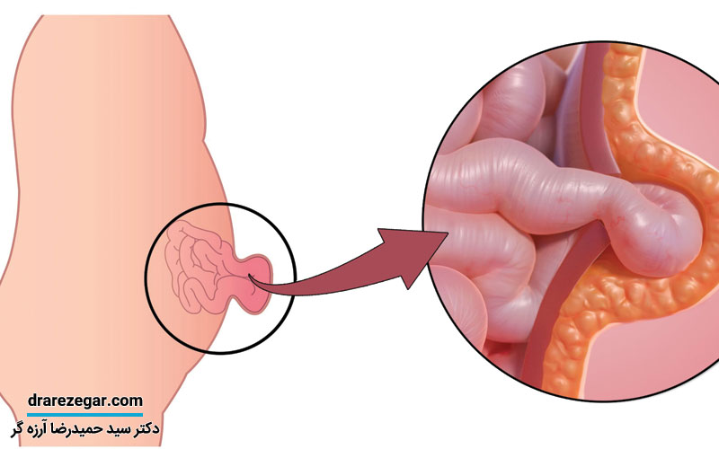 فتق یا باد فتق چیست