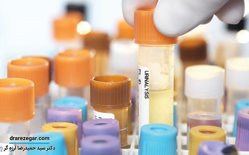 علائم دفع پروتئین در ادرار