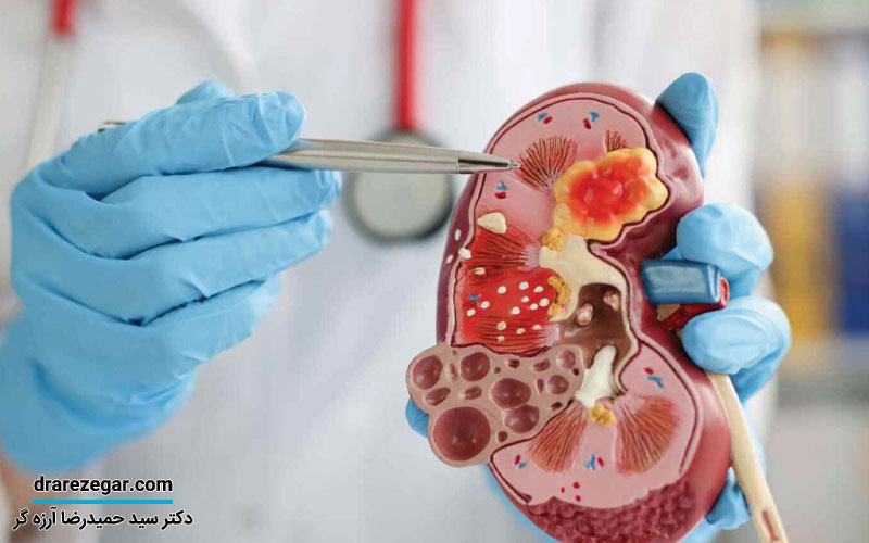 علت شیوع سنگ کلیه کودکان