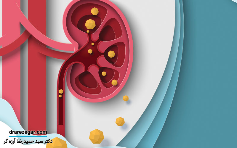علت شیوع سنگ کلیه کودکان