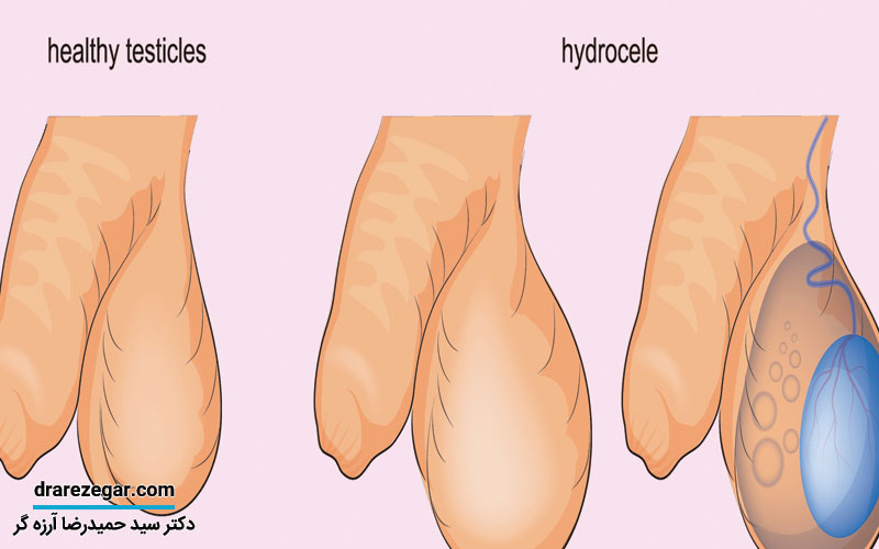 هیدروسل چه عوارضی دارد