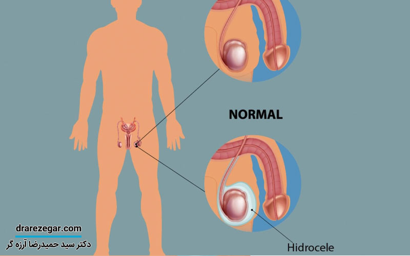 هیدروسل چه عوارضی دارد