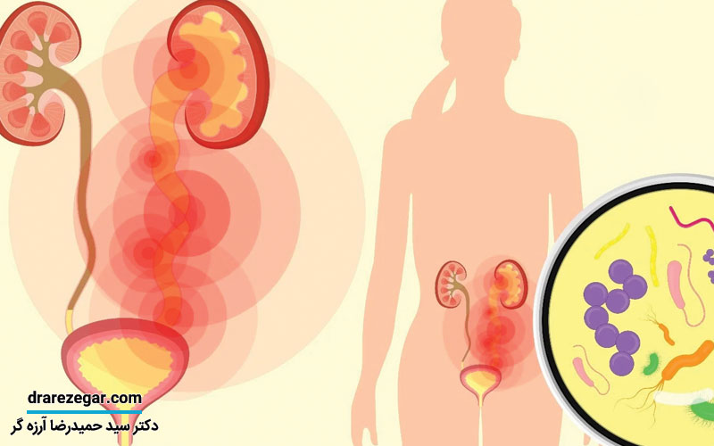 انواع اختلالات مثانه