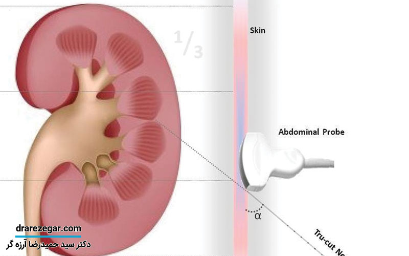 نمونه برداری کلیه