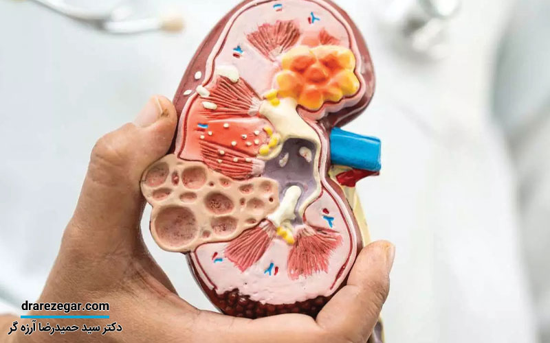 نمونه برداری کلیه