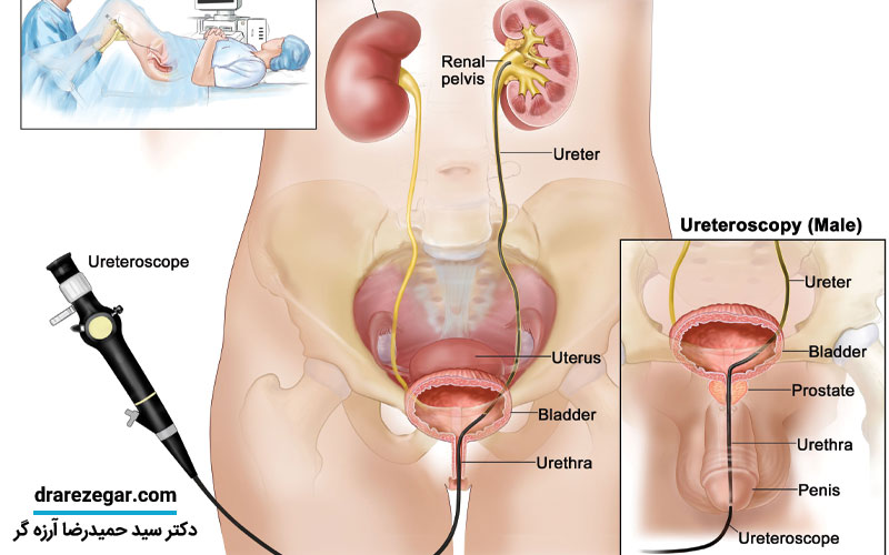 روش‌ های درمان سرطان حالب