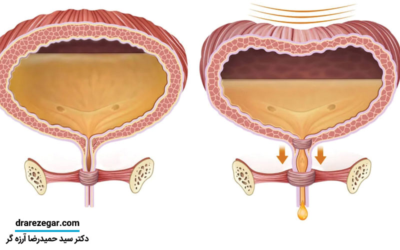 مثانه عصبی یا نورولوژیک چیست