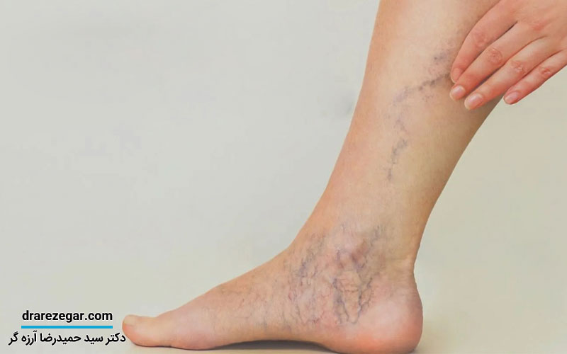 استاز و ورم کلیه چیست