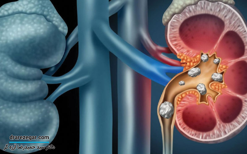 علائم دفع سنگ کلیه