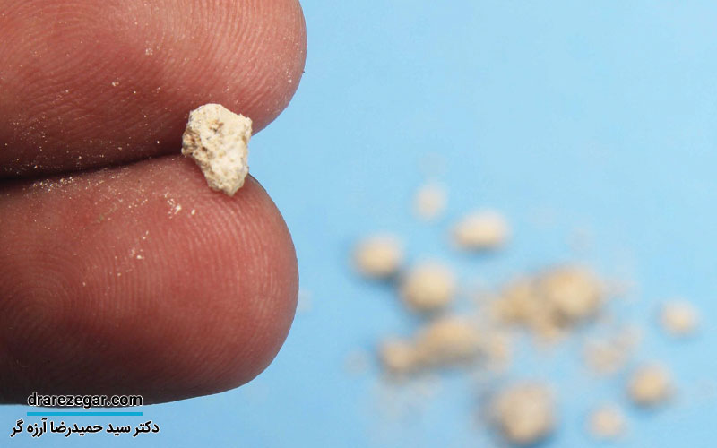 علائم دفع سنگ کلیه