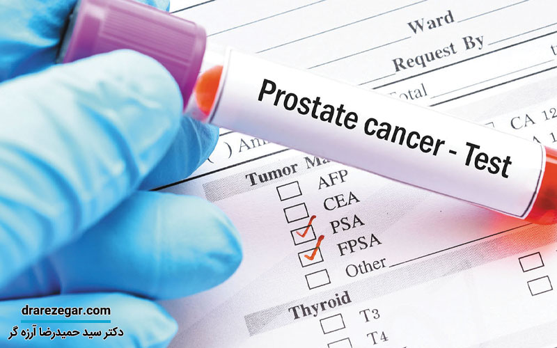 تست غربالگری سرطان پروستات