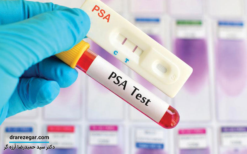 تست غربالگری سرطان پروستات