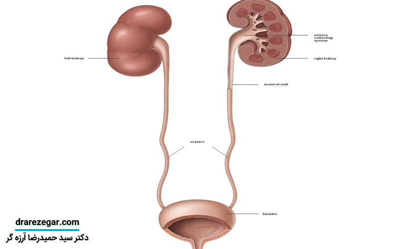 انواع اختلالات مادرزادی سیستم ادراری
