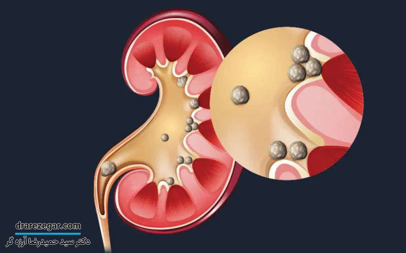 سنگ کلیه چطور درمان می شود