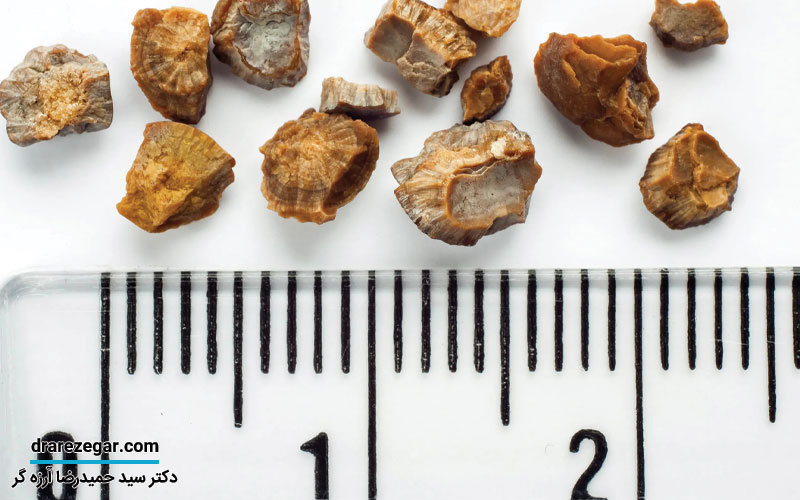 سنگ کلیه چطور درمان می شود