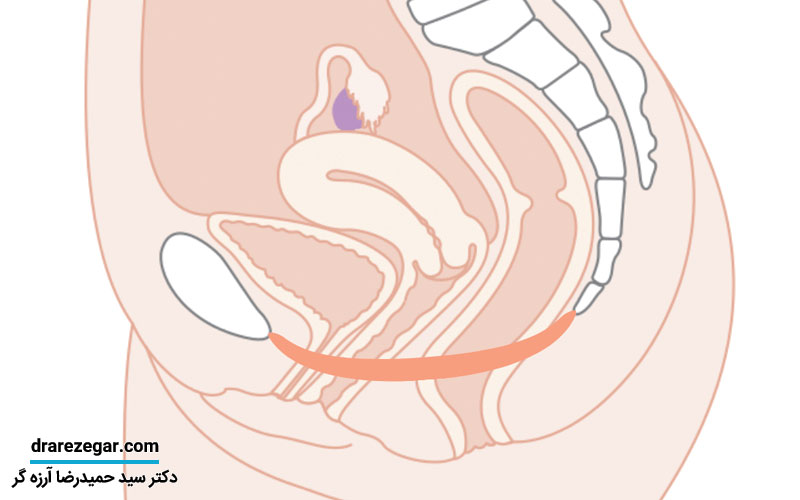 جلوگیری از افتادگی مثانه