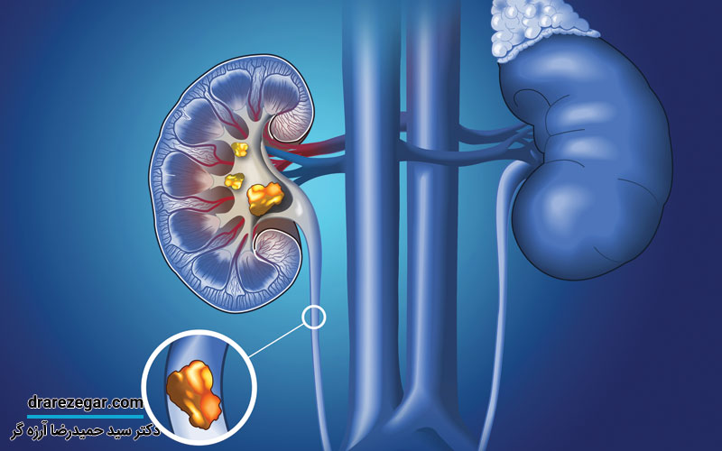 بهترین راه های جلوگیری از سنگ کلیه