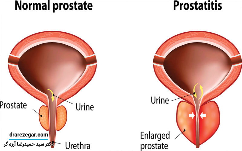 التهاب پروستات چیست