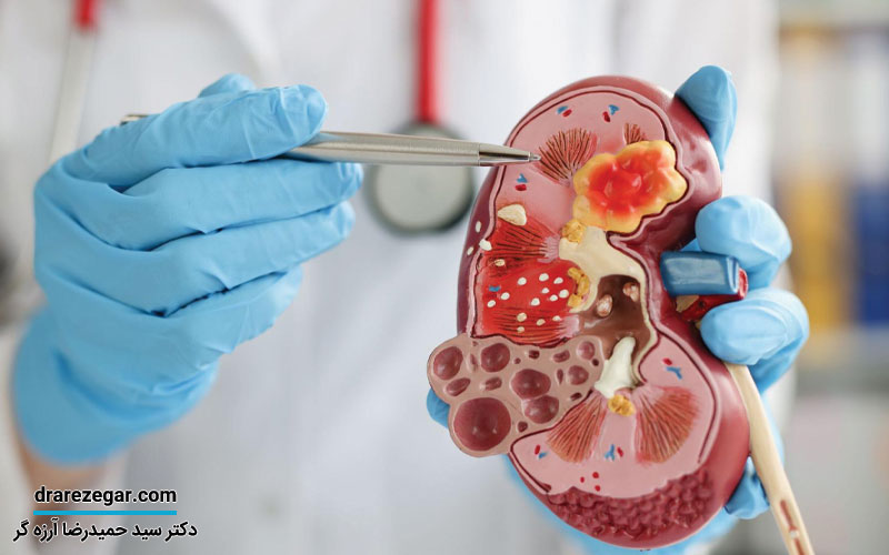 دلیل درد شدید کلیه چیست