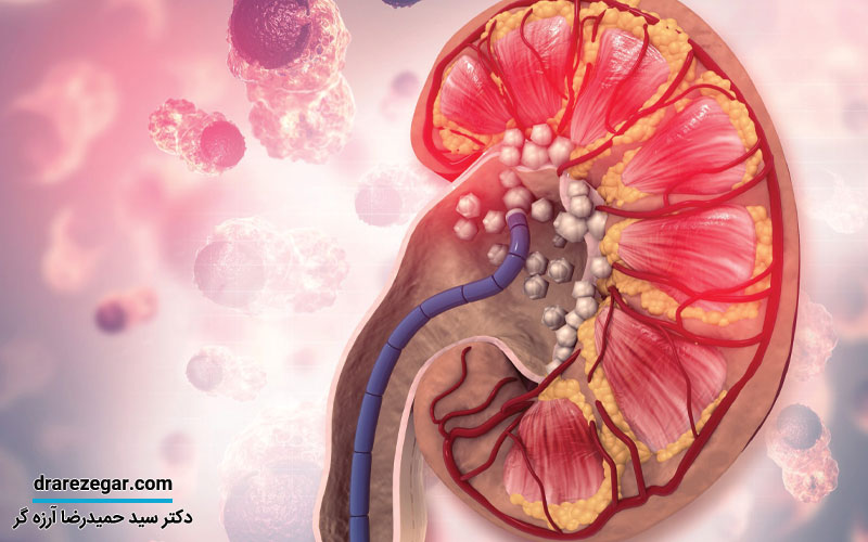 دلیل درد شدید کلیه چیست