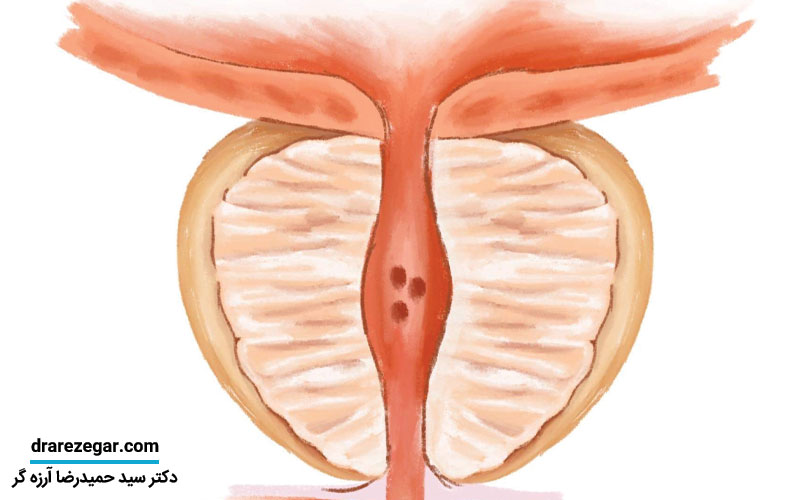 پروستات چیست