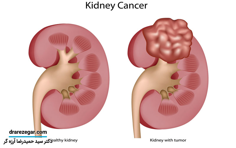 درمان سرطان کلیه چطور است