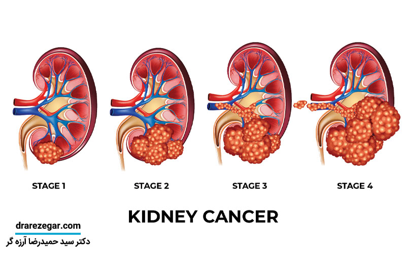 درمان سرطان کلیه چطور است