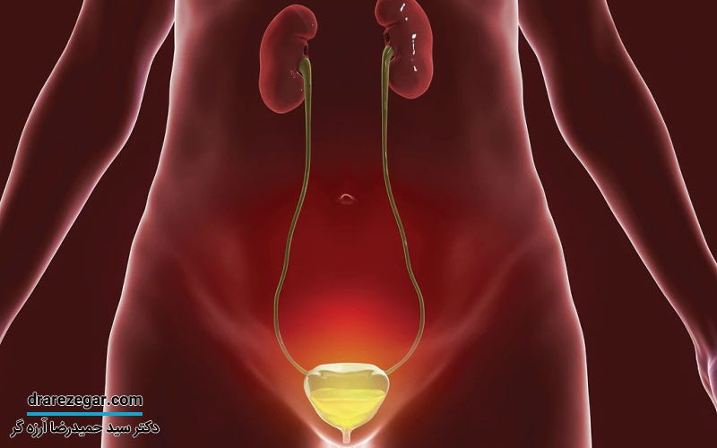 بیش فعالی مثانه چیست