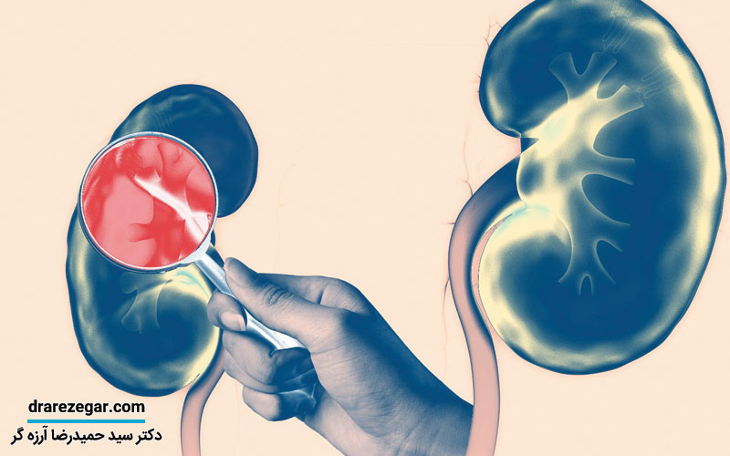 انواع درمان نارسایی کلیه