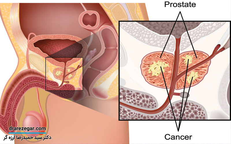 انواع بیماری های پروستات