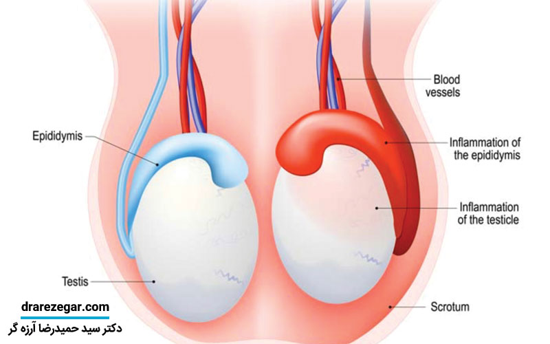 علت ورم بیضه چیست
