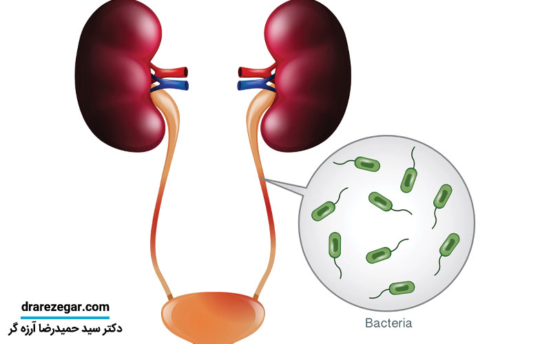 درمان عفونت ادراری