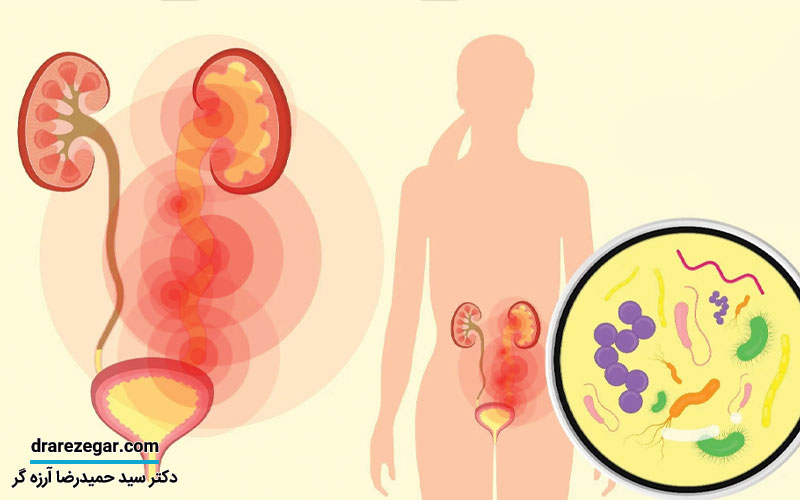 درمان عفونت ادراری